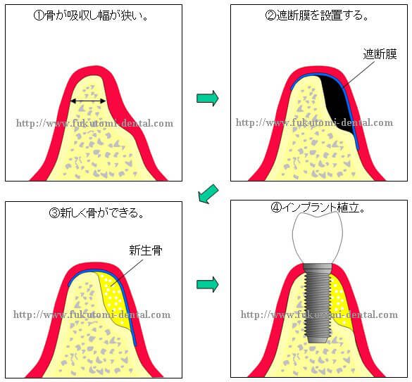 骨再生誘導法｜相模原市の歯医者【福富歯科クリニック】